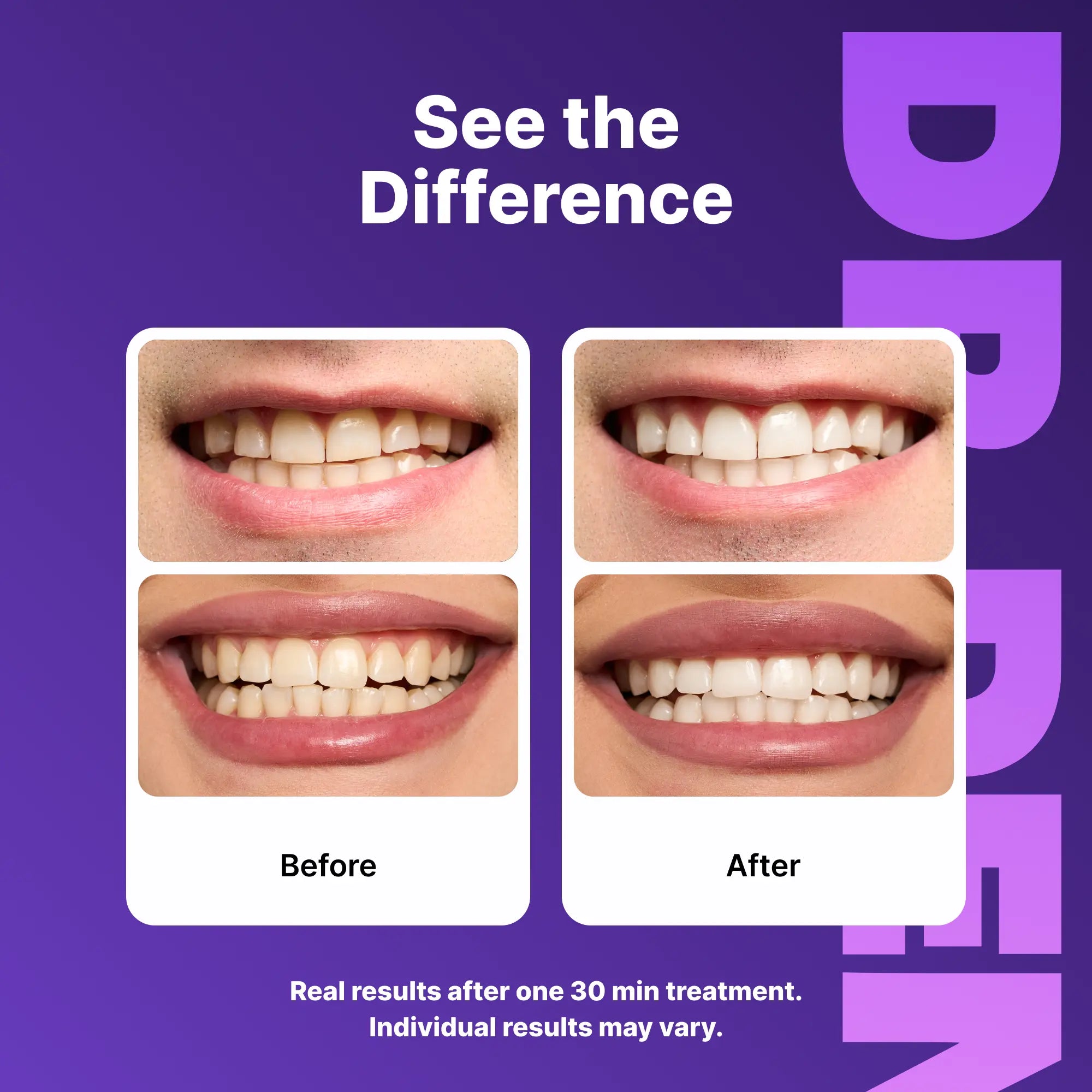 Experience a Dazzling Smile with DRDENT Purple Teeth Whitening Strips - 7/21 Sessions for Safe, Non-Sensitive Whitening - Peroxide-Free Formula!
